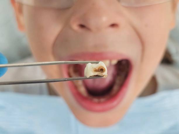 Best Emergency Tooth Extraction in Peculiar, MO